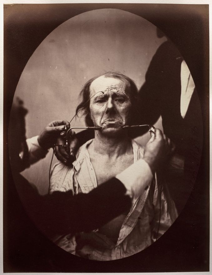 Figure 45: Contraction électrique forte des triangulaires des lèvres et des sourciliers: douleur et déspoir by Guillaume-Benjamin-Amand Duchenne